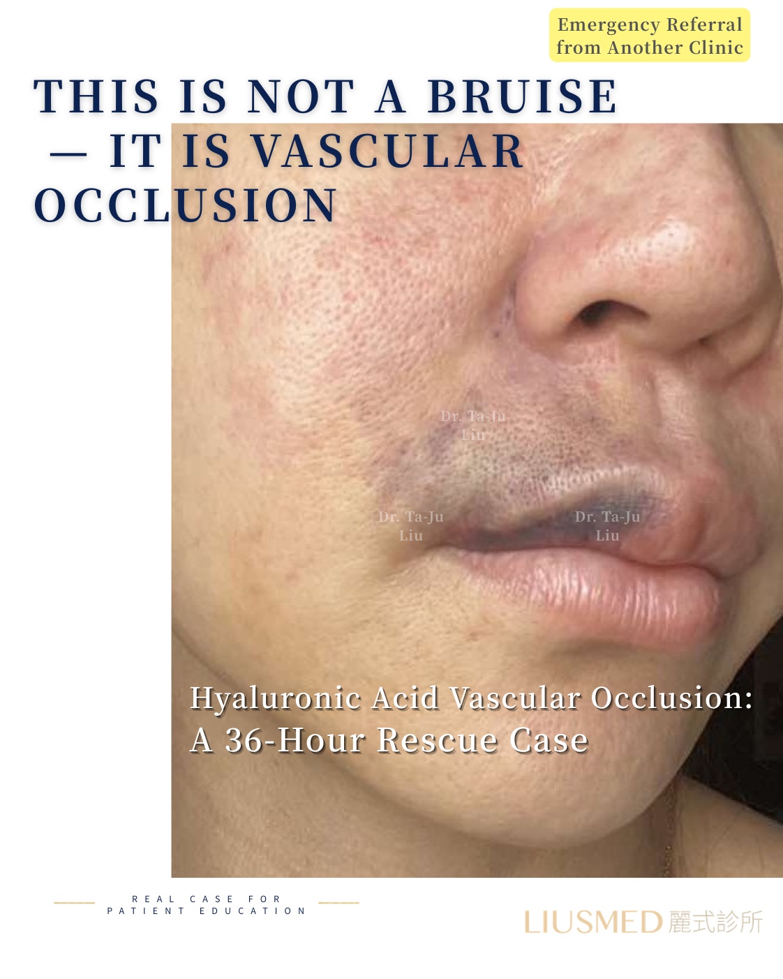 FILLER REVISION Case Study: 36-Hour Filler Vascular Embolism Rescue via Ultrasound-Guided Intra-Arterial Hyaluronidase