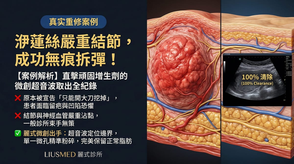 【FILLER REVISION 案例】洢蓮絲嚴重結節，微創超音波導引取出全紀錄