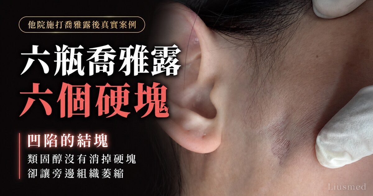 【案例】喬雅露六瓶後多處硬塊:超音波、抽出物,與類固醇留下的凹陷
