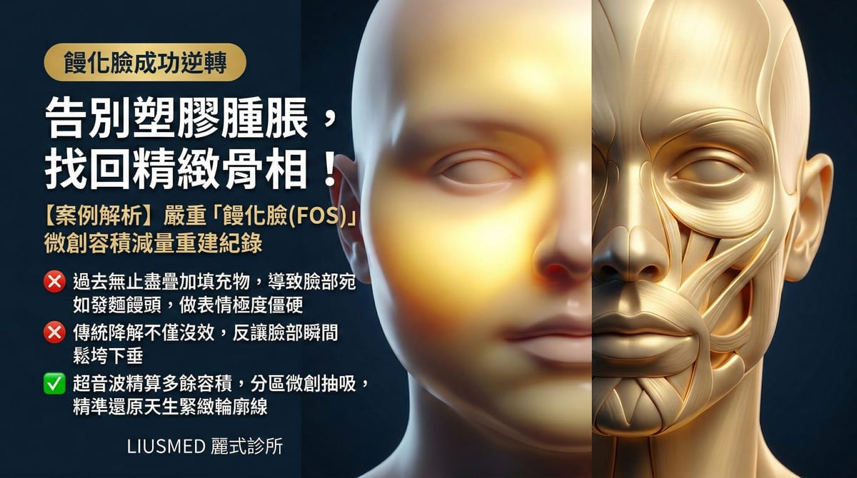【FILLER REVISION 案例】嚴重饅化臉（FOS）微創全臉取出重建紀錄