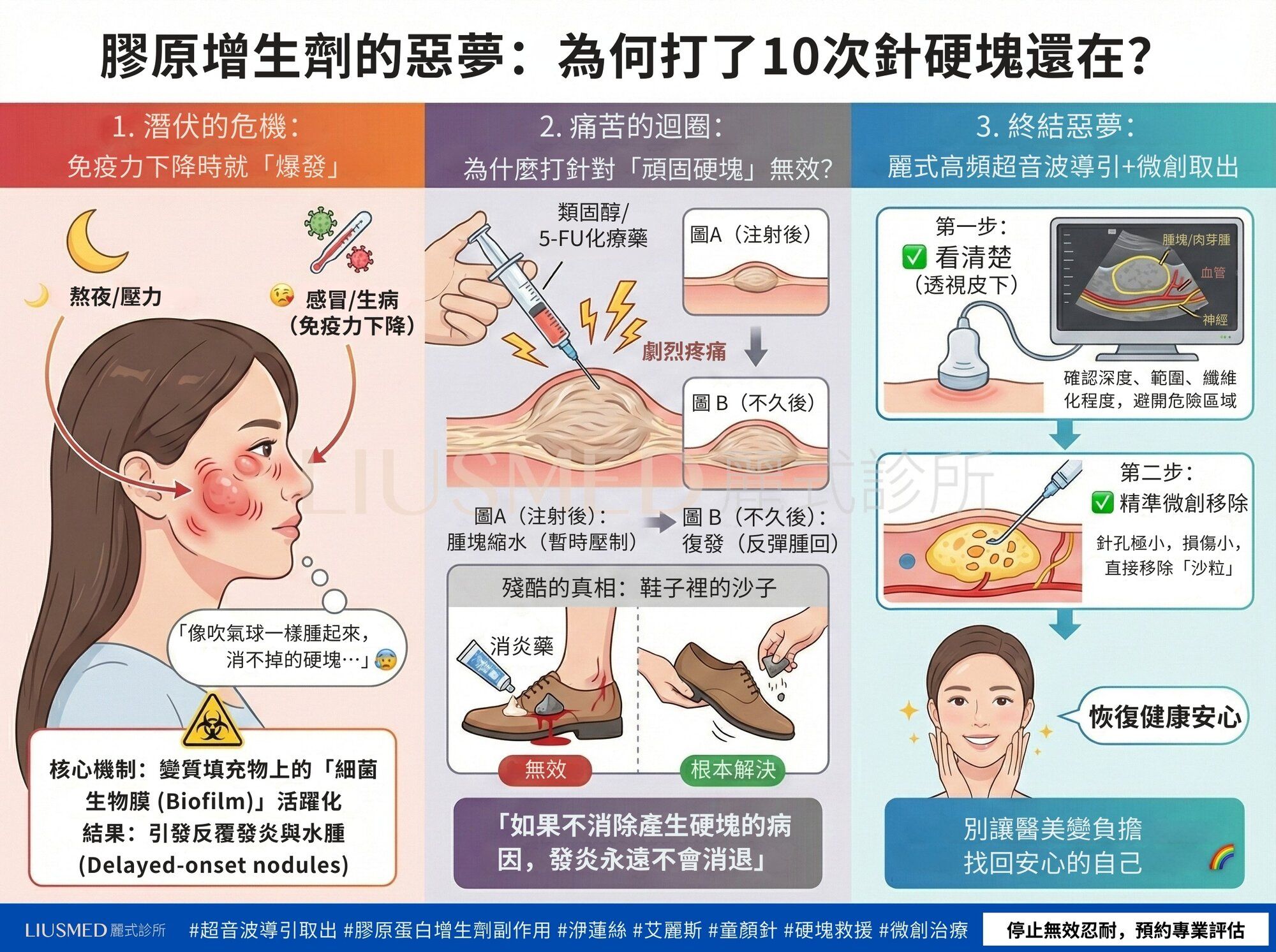 超音波導引膠原增生劑硬塊取出