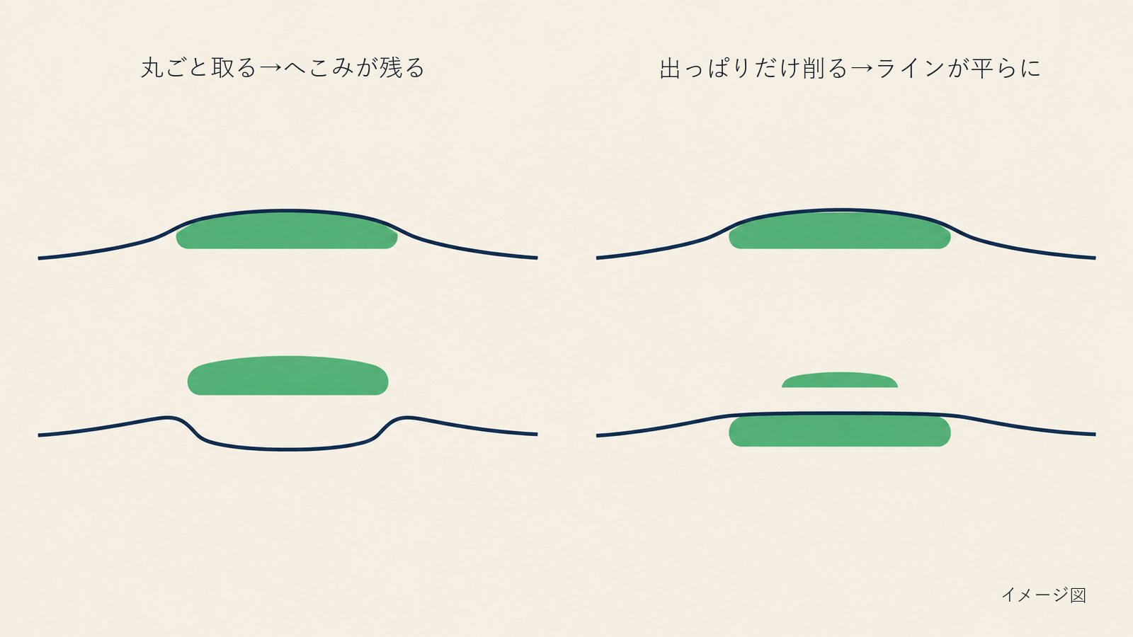 イメージ図:左は真皮移植片を一本丸ごと取り、輪郭にへこみが残る様子。右は輪郭より高い部分だけを削り、残りはそのままで輪郭がなめらかに戻る様子