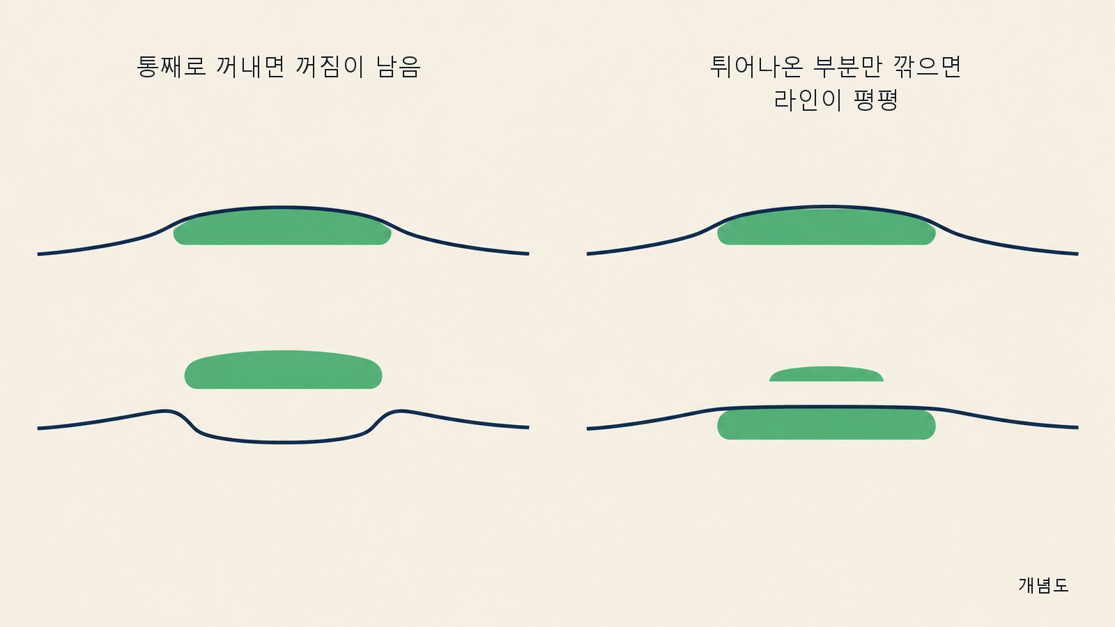 개념도: 왼쪽은 진피 이식물을 통째로 꺼내 윤곽에 꺼짐이 남은 모습, 오른쪽은 윤곽보다 높은 부분만 깎고 나머지는 그대로 두어 윤곽이 다시 매끄러워진 모습
