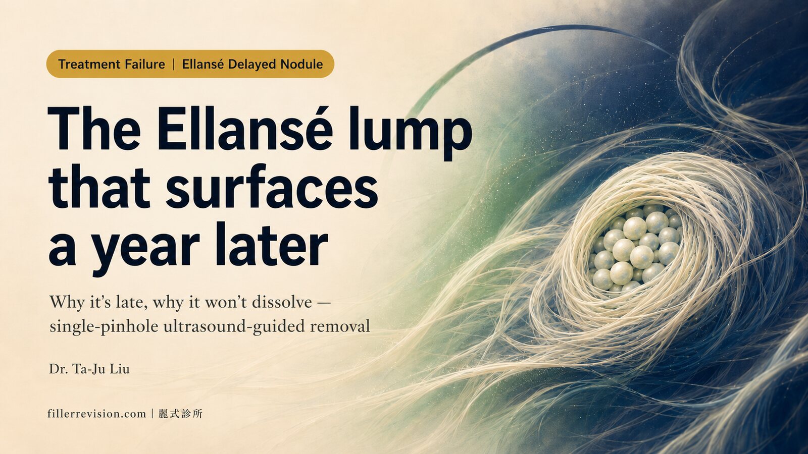 Ellansé Lumps 1–2 Years Later? Why PCL Delayed-Onset Nodules Surface Late — and How to Remove Them Safely