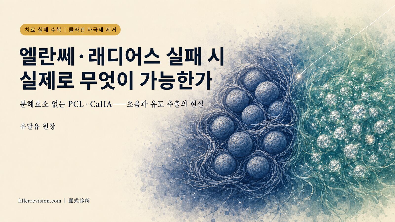 엘란쎄(Ellansé)와 래디어스(Radiesse) 제거: 실제로 무엇이 가능한가