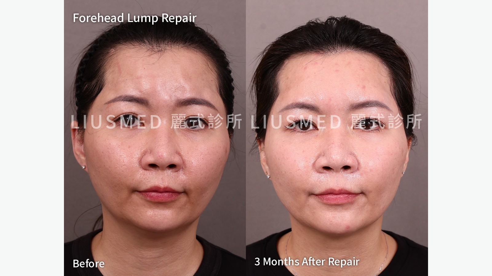 After a Filler Lump Is Treated, When Can You Tell If It Worked? Timing for Flushing, Hyaluronidase, Steroids and Removal