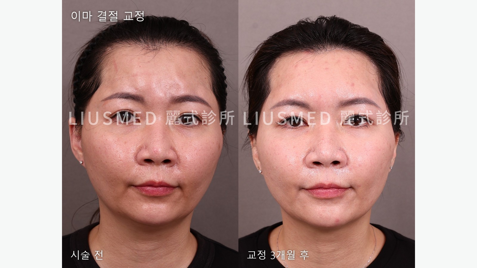 필러 멍울을 처치한 뒤, 효과는 언제 판단할 수 있을까: 세척·히알루로니다제·스테로이드·제거별 시점