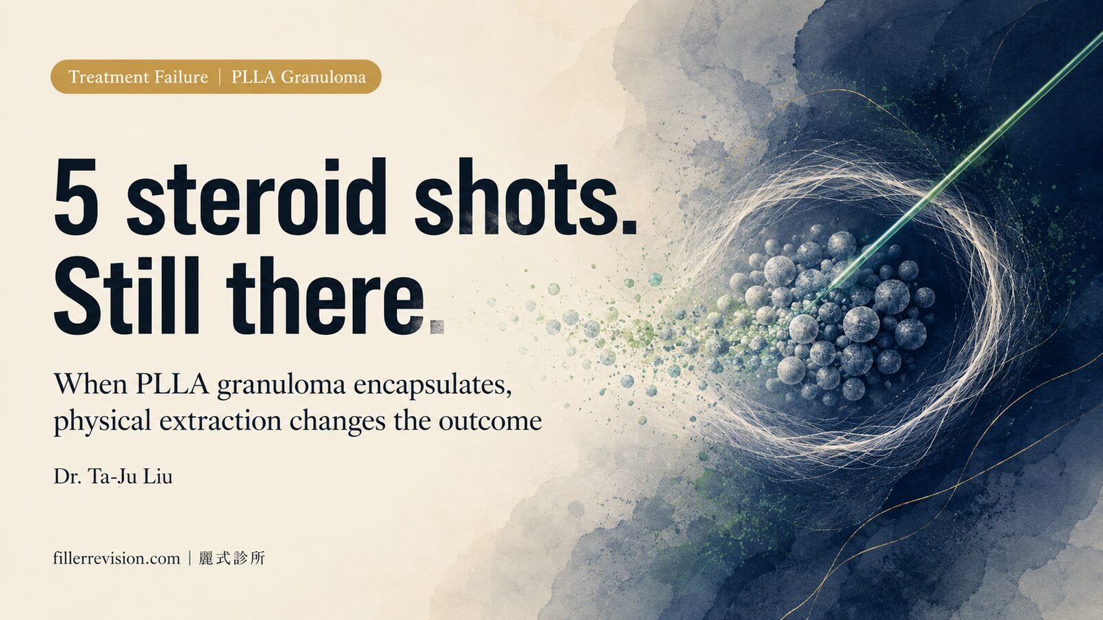 Sculptra Granuloma Complete Guide: From Nodule Assessment to Options After Steroid Failure