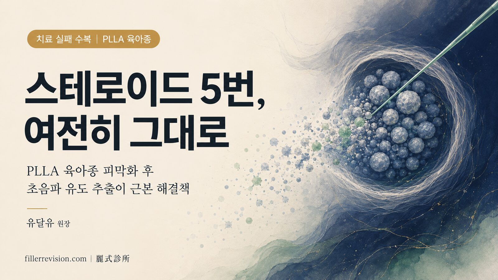 스컬트라 육아종 완전 가이드: 결절 구별부터 스테로이드 치료 실패 후 수복 옵션까지