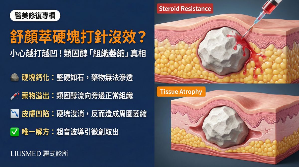 舒顏萃硬塊類固醇治療失敗？FILLER REVISION 的微創取出修復方案