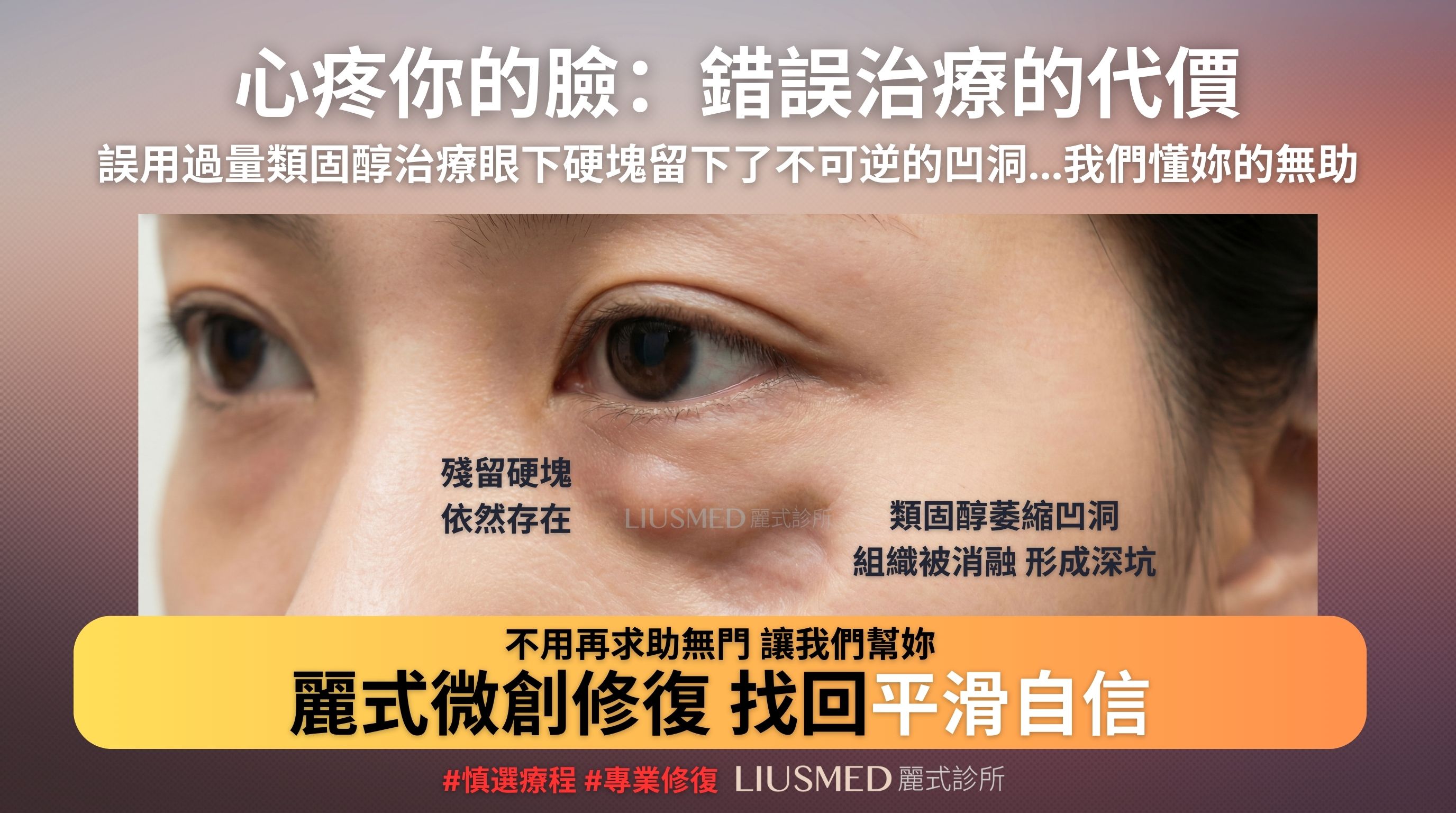 眼下填充少女針產生硬塊後誤打類固醇導致組織萎縮凹陷
