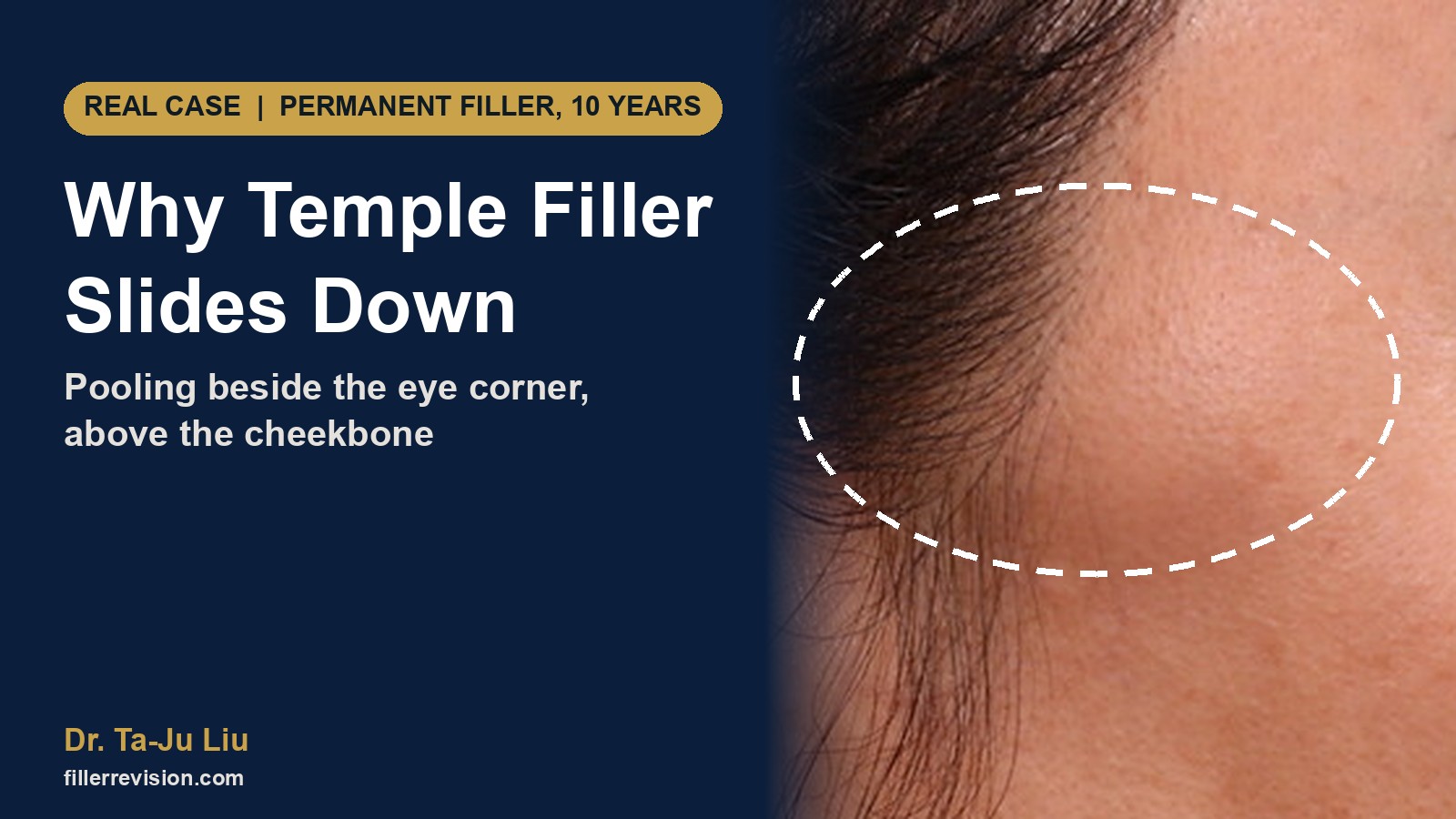 Temple Filler Migration: Why It Pools Near the Eye Corner, Above the Cheekbone