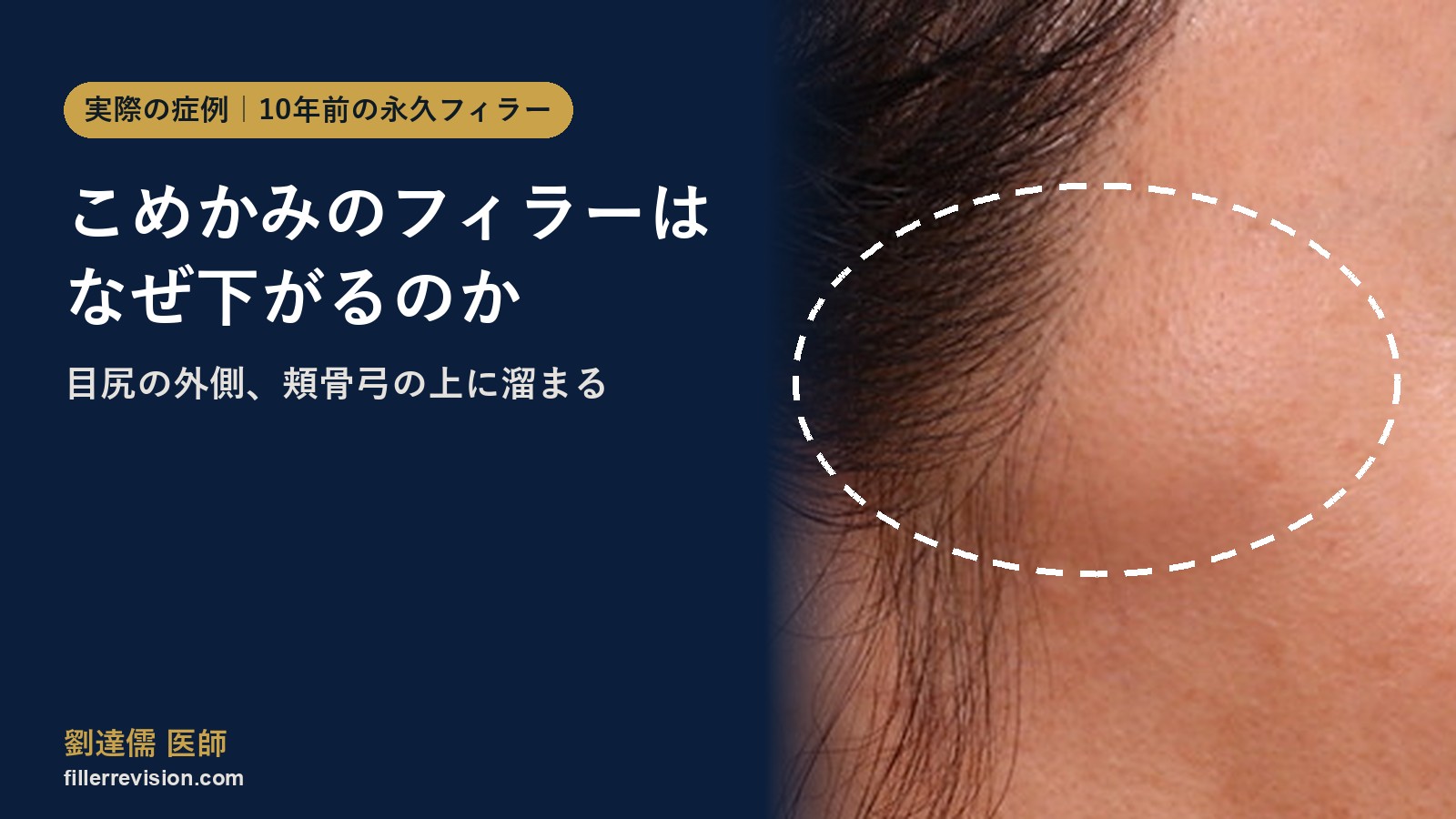 こめかみのフィラーが下がってしこりに?目尻の外側、頬骨弓の上に溜まる理由