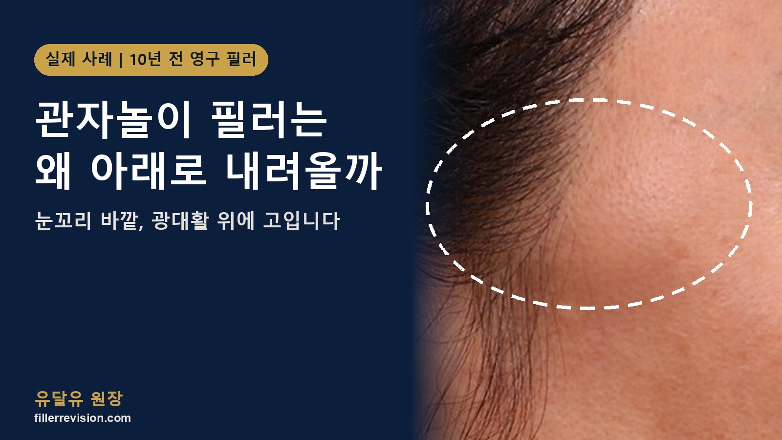관자놀이 필러가 아래로 내려와 멍울이 된다면? 눈꼬리 바깥, 광대활 위에 고이는 이유
