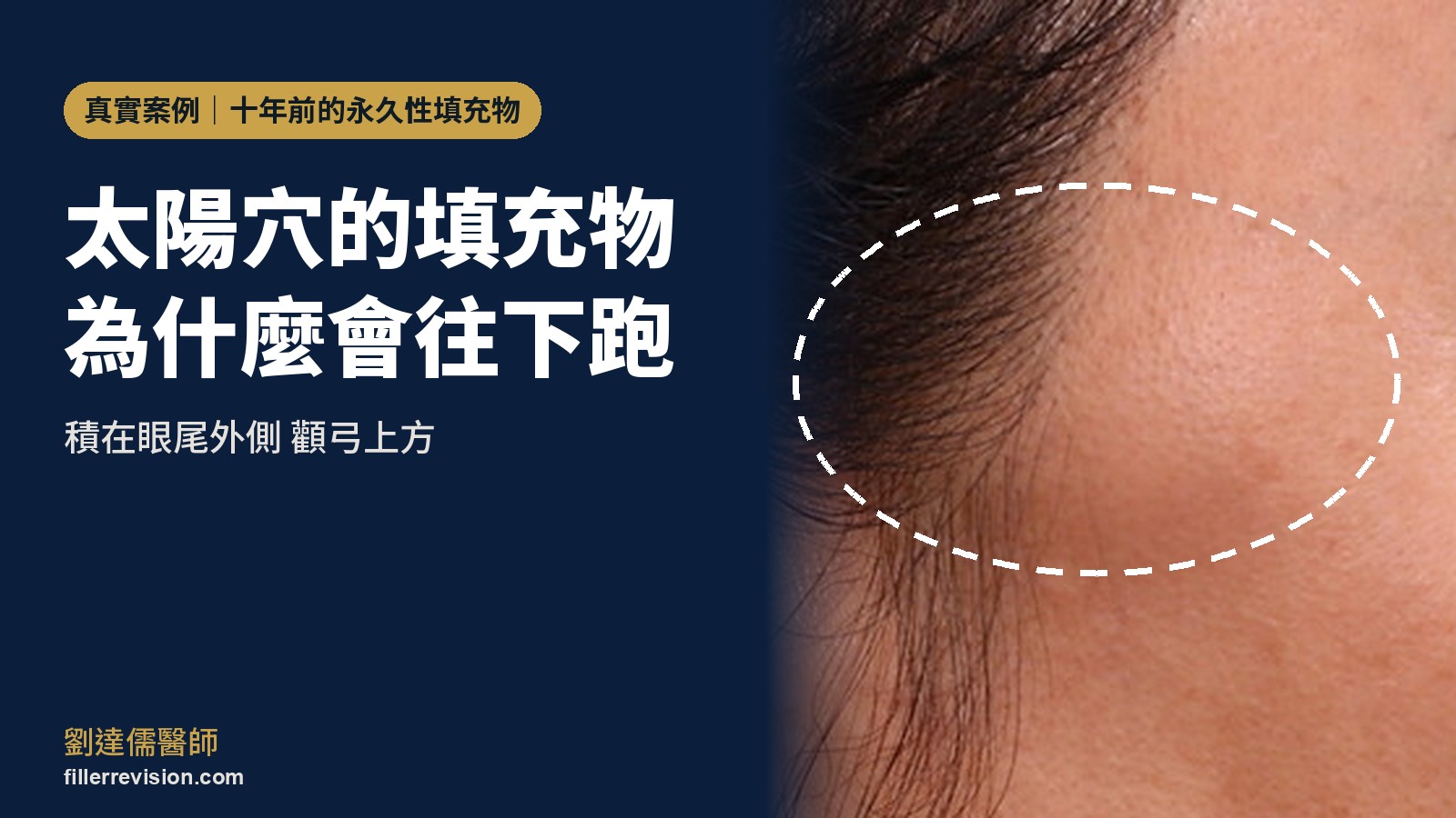 太陽穴填充物往下跑、積在眼尾旁變硬塊?注射層次、用量與按摩的提醒