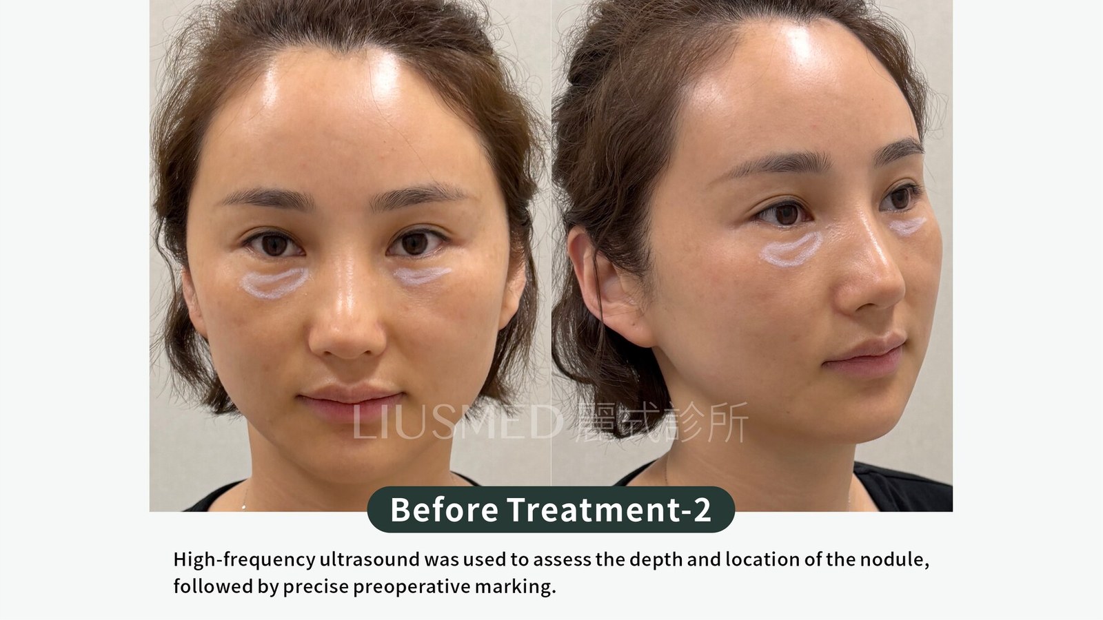 There's Already a Bulge Under Your Eye — Can Another Injection "Cover It Flat"? Three Things to Settle Before the Second Needle