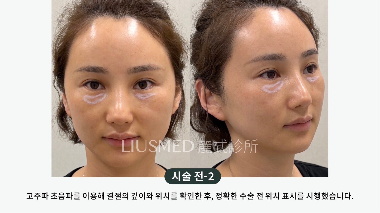 눈밑이 이미 튀어나왔는데, 한 번 더 넣어 「덮어서 평평하게」 할 수 있을까? 두 번째 주사 전에 정리할 세 가지