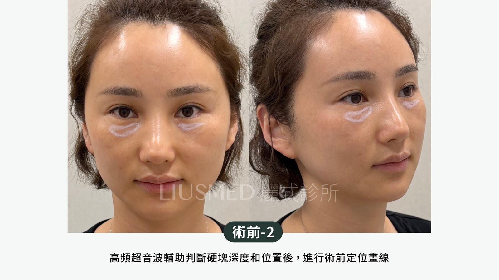 眼下已經凸起來了，還能再補一針把它「蓋平」嗎？第二針之前該先想的三件事