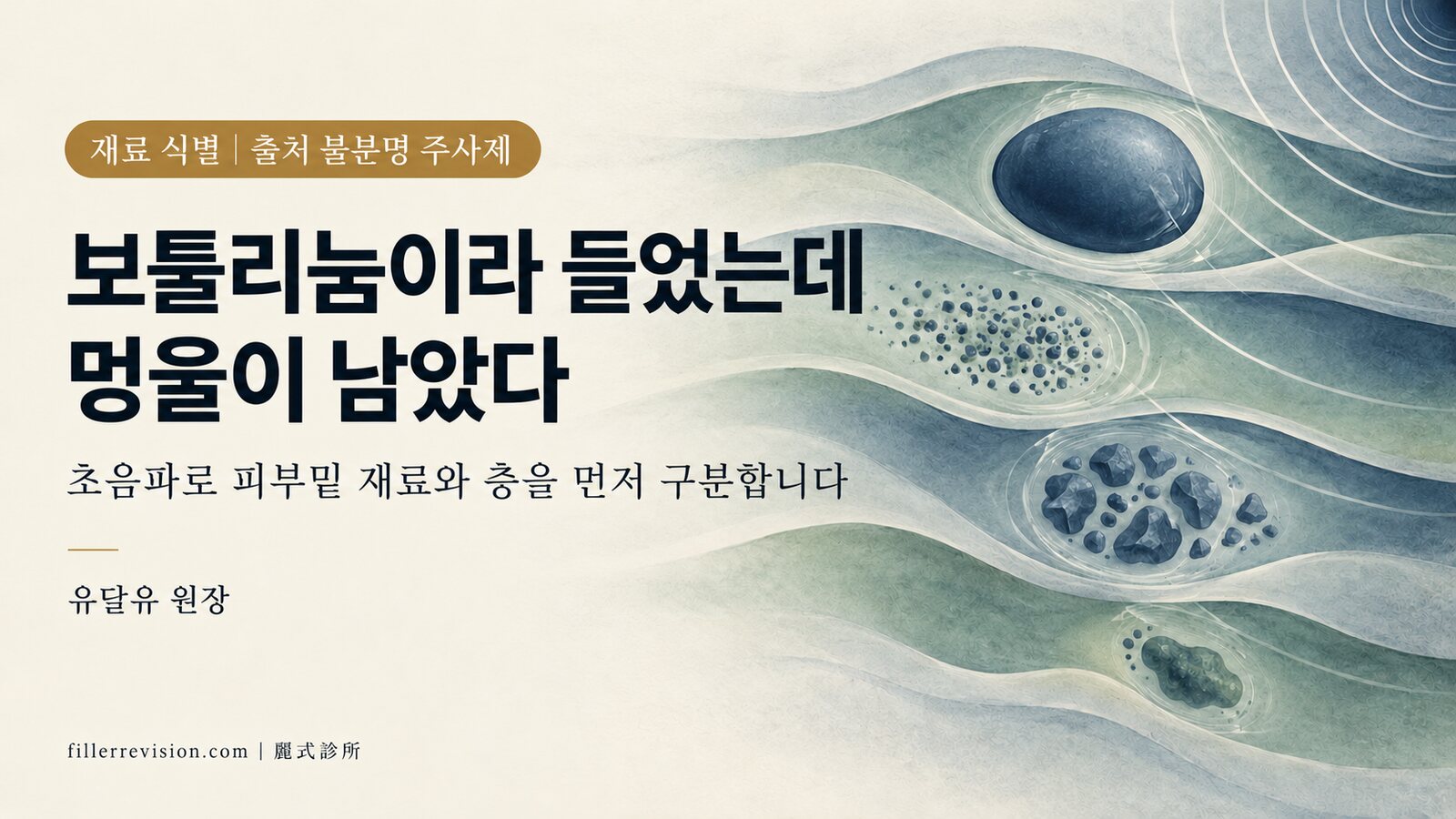 보툴리눔 톡신이라고 들었는데 멍울이 남았습니다: 주입된 것을 식별하는 방법