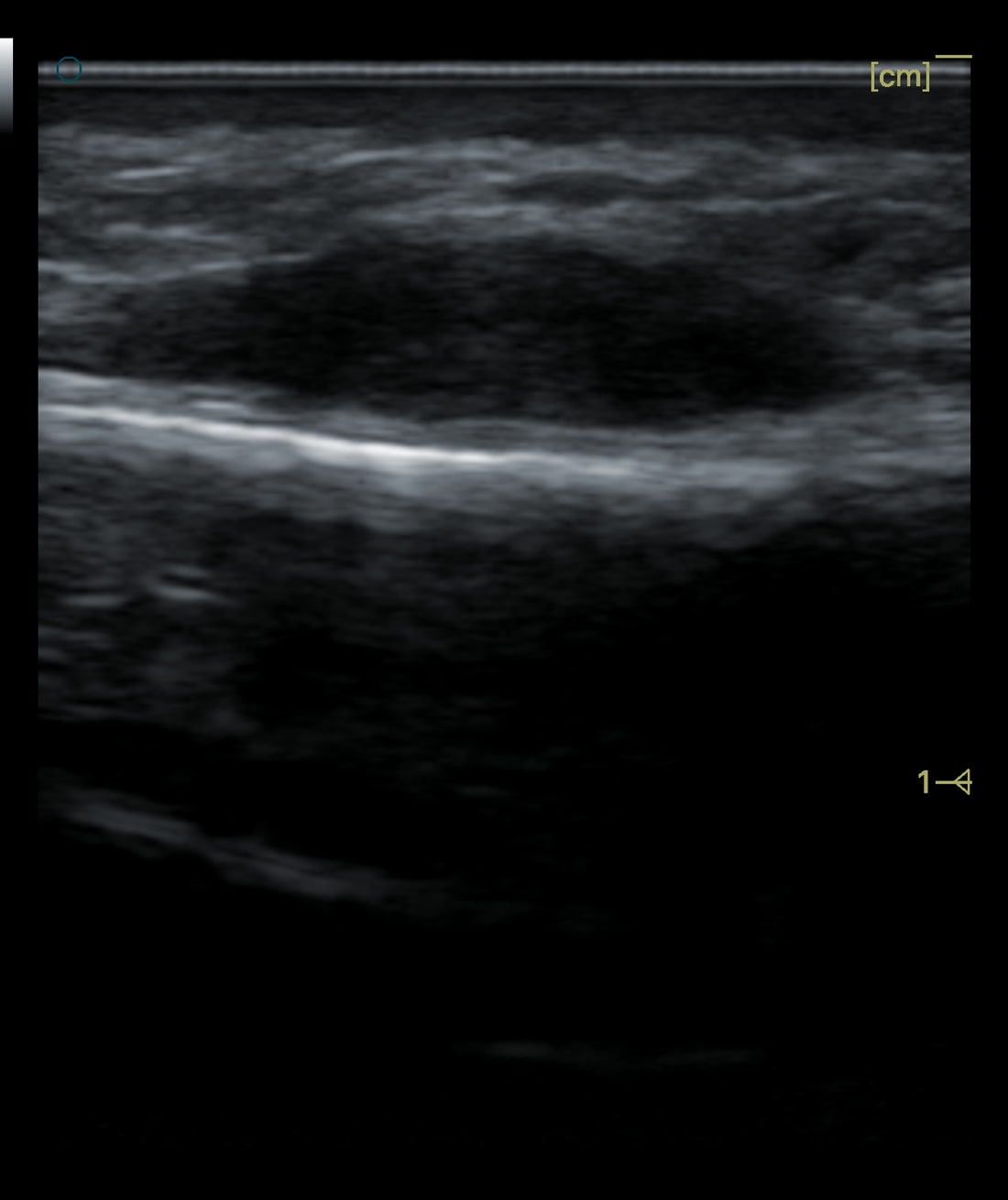 Ultrasound - コラーゲン刺激剤による隆鼻から15年後の鼻骨しこり——超音波で残留を確認、低侵襲摘出を予定