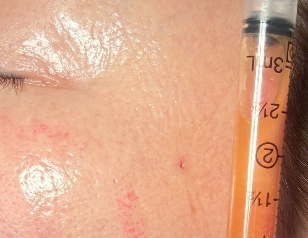 Real case: during single-pinhole minimally invasive extraction. The small red mark in the centre of the photo is the entry point; the syringe on the right holds fat just taken out of the face (image shared with patient consent).