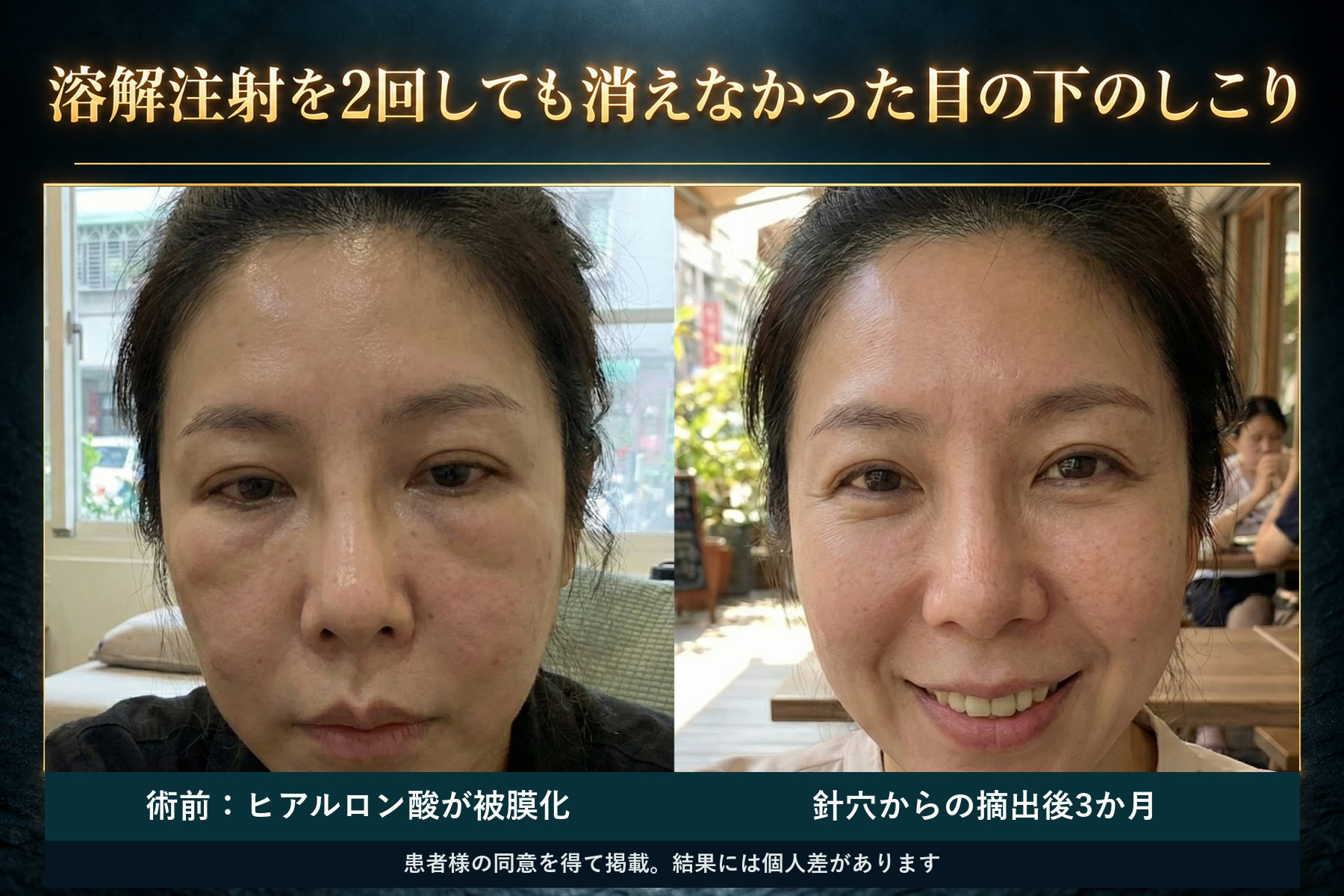 被包化ヒアルロン酸除去症例