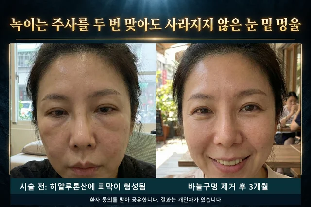 시술 전