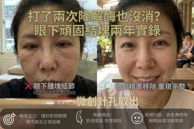 眼下那顆「凸凸」的東西，跟了我三年...