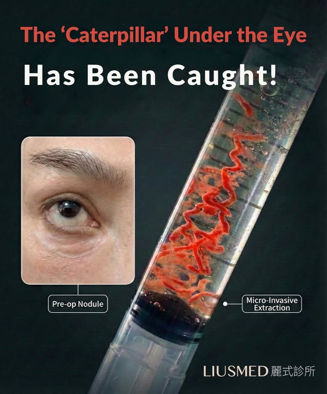 Under-eye Ellansé nodule removed just in time