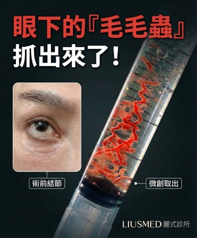 眼下伊蓮絲結節，趕在過年前請出來