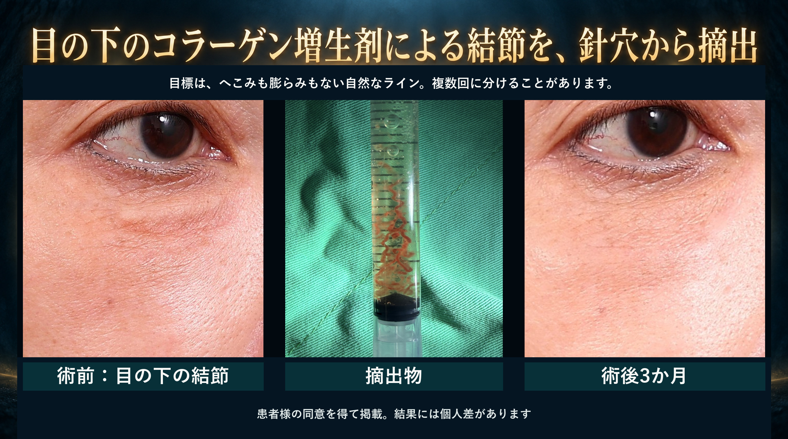 術後1か月経過観察
