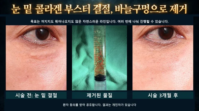 시술 후