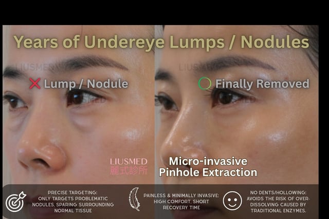 Ellansé apple cheeks "pillow face," stiff expressions