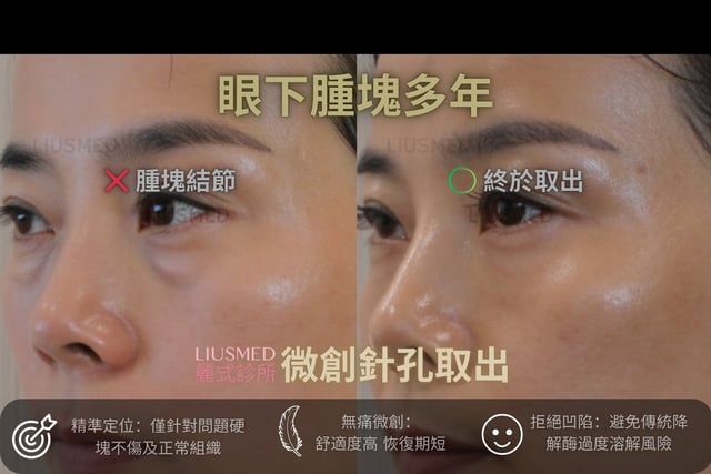 伊蓮絲蘋果肌「饅化」，笑起來像麵包超人