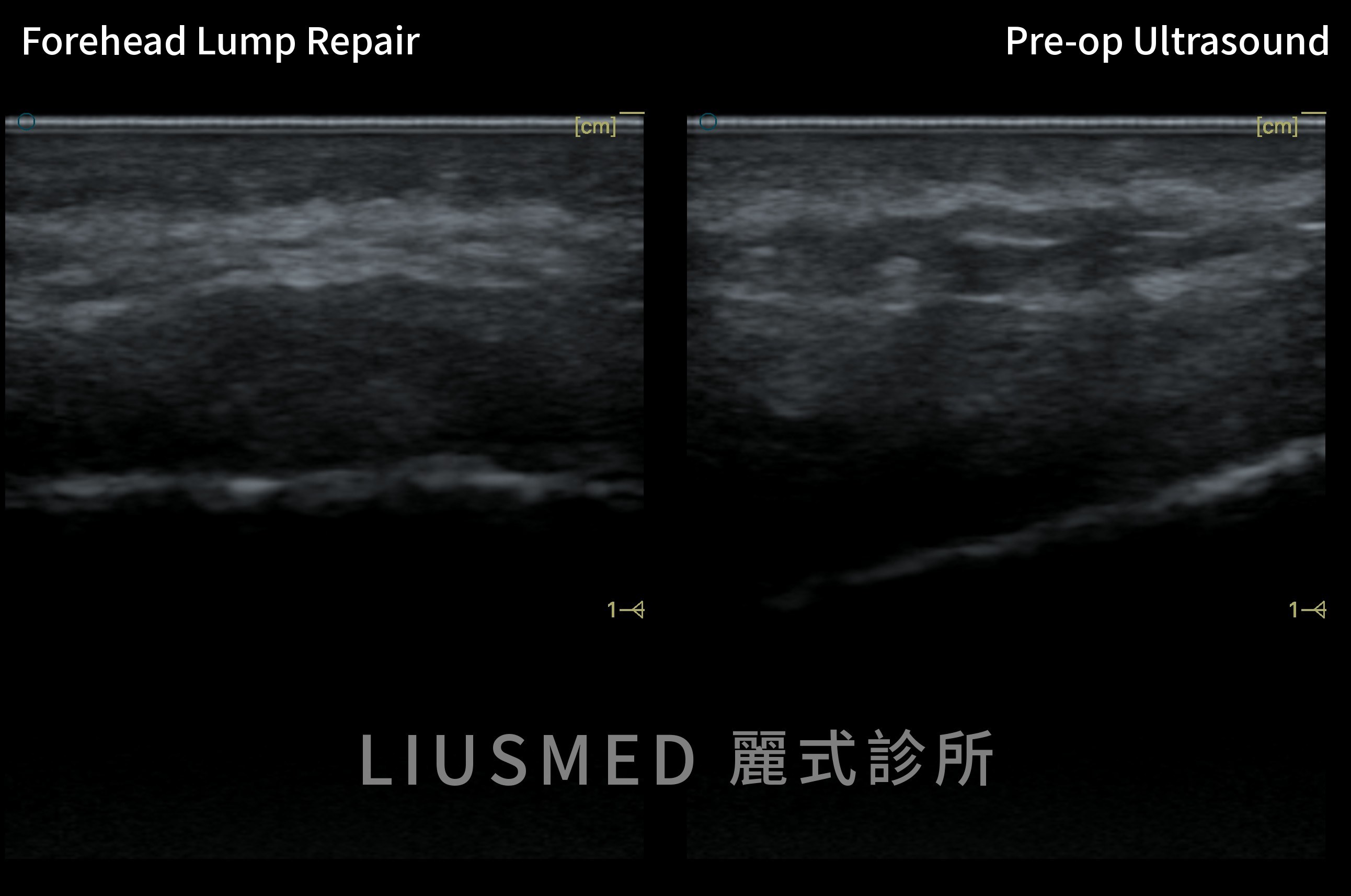 Ultrasound — Two Years of Ellansé Forehead Lumps That Hyaluronidase and a Flush Could Not Fix — Mapped by Ultrasound, Removed Through Pinholes, Judged at Three Months