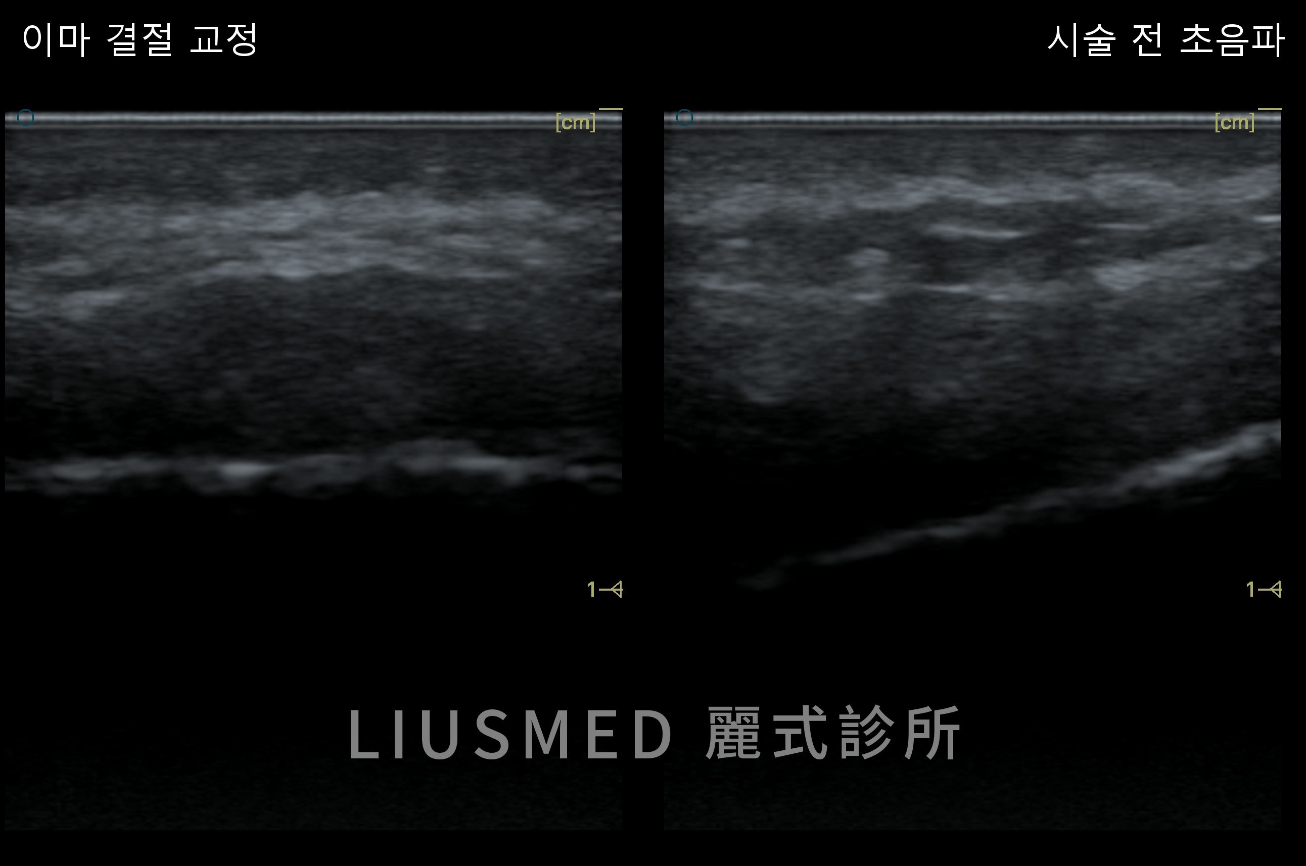 초음파 — 2년 된 이마 엘란쎄 결절, 히알루로니다제도 세척도 소용없던 증례——초음파로 결절 지도를 그려 바늘구멍으로 제거, 판단은 3개월 후