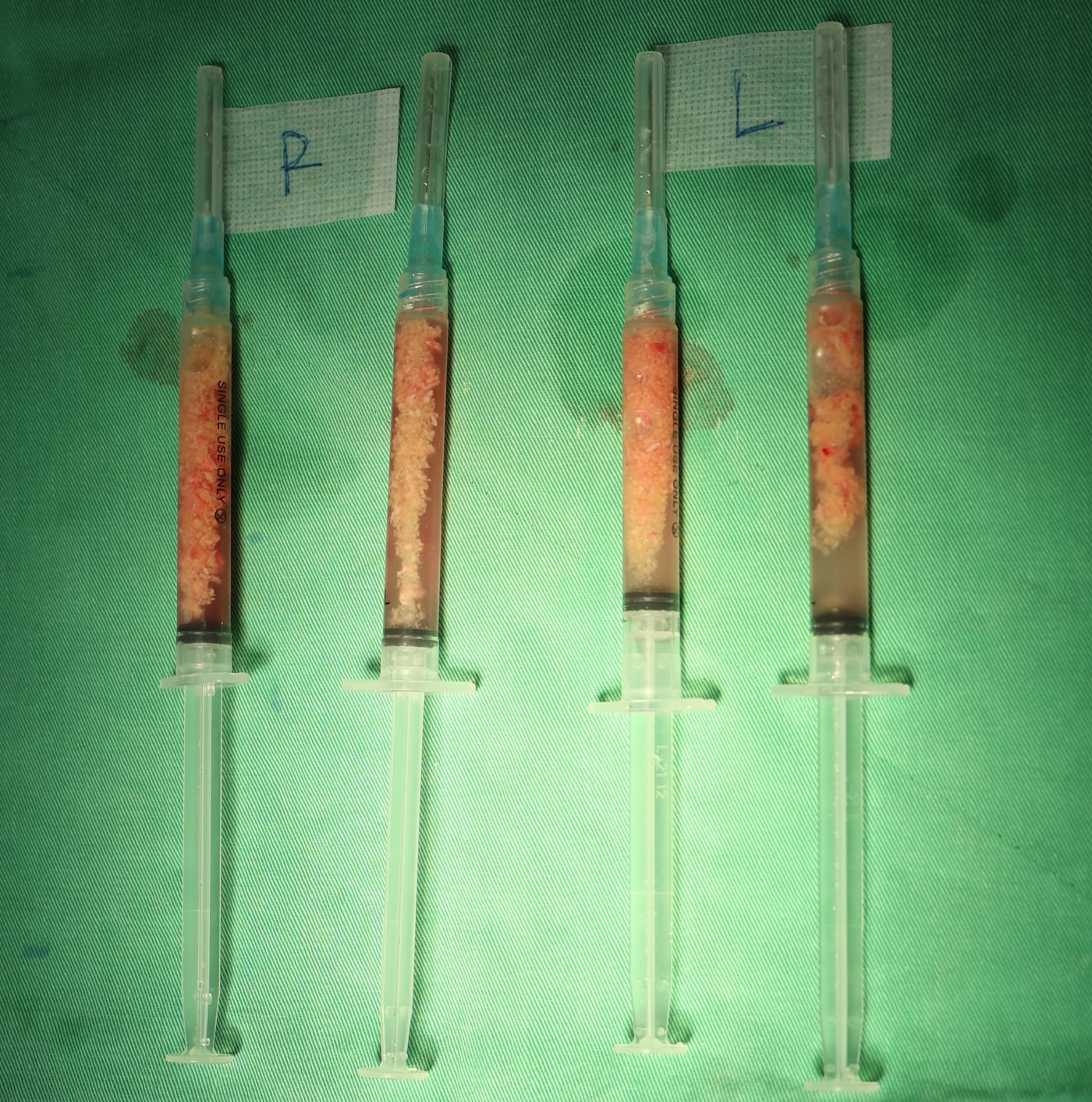 Real case: material extracted from both cheeks during the second session, collected in syringes labelled separately for the right and left sides (image de-identified, shared with patient consent).
