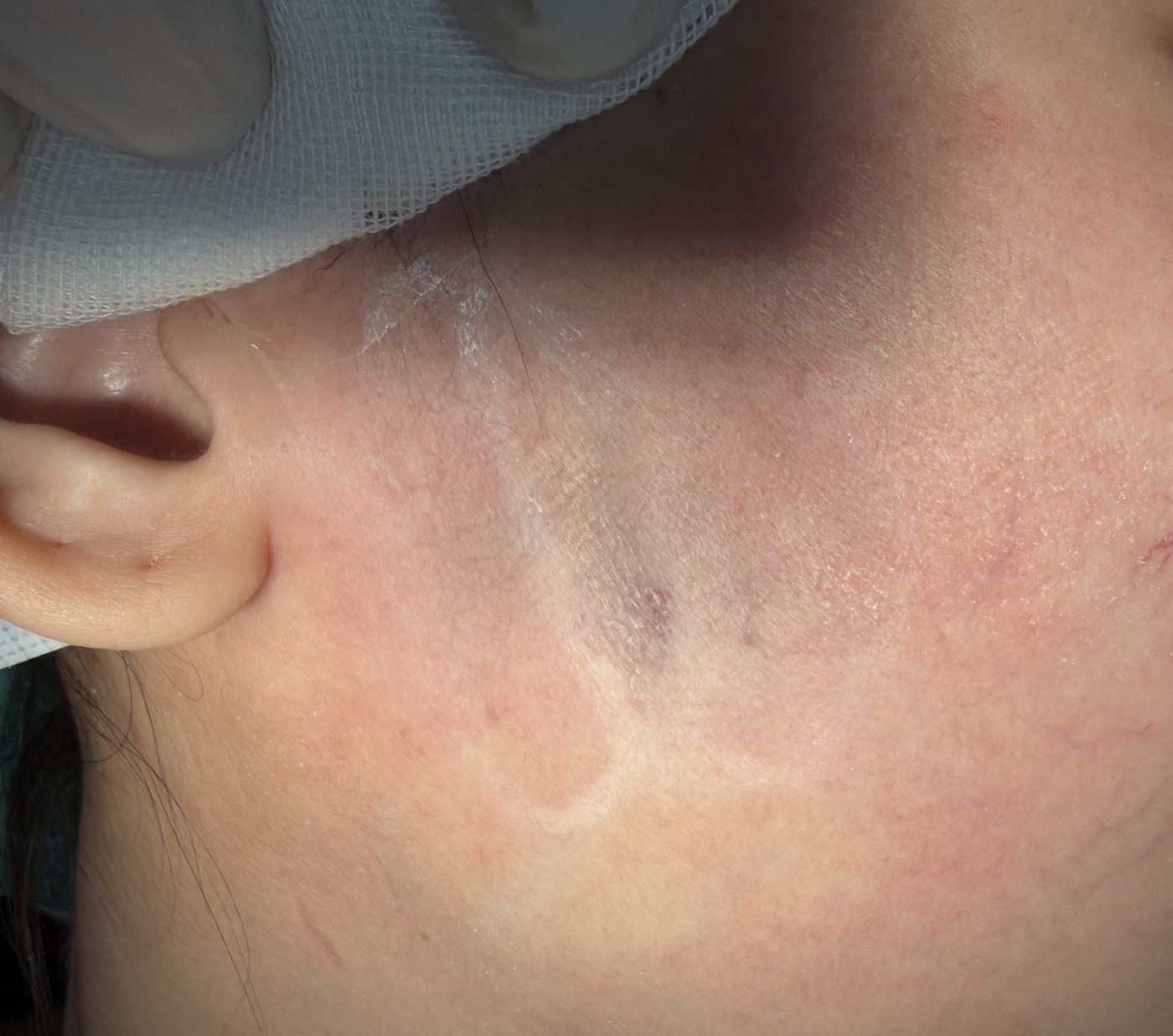 Real case: the same site photographed immediately after extraction at the second session three weeks later; the nodule has been removed and the existing depression remains (image de-identified, shared with patient consent).