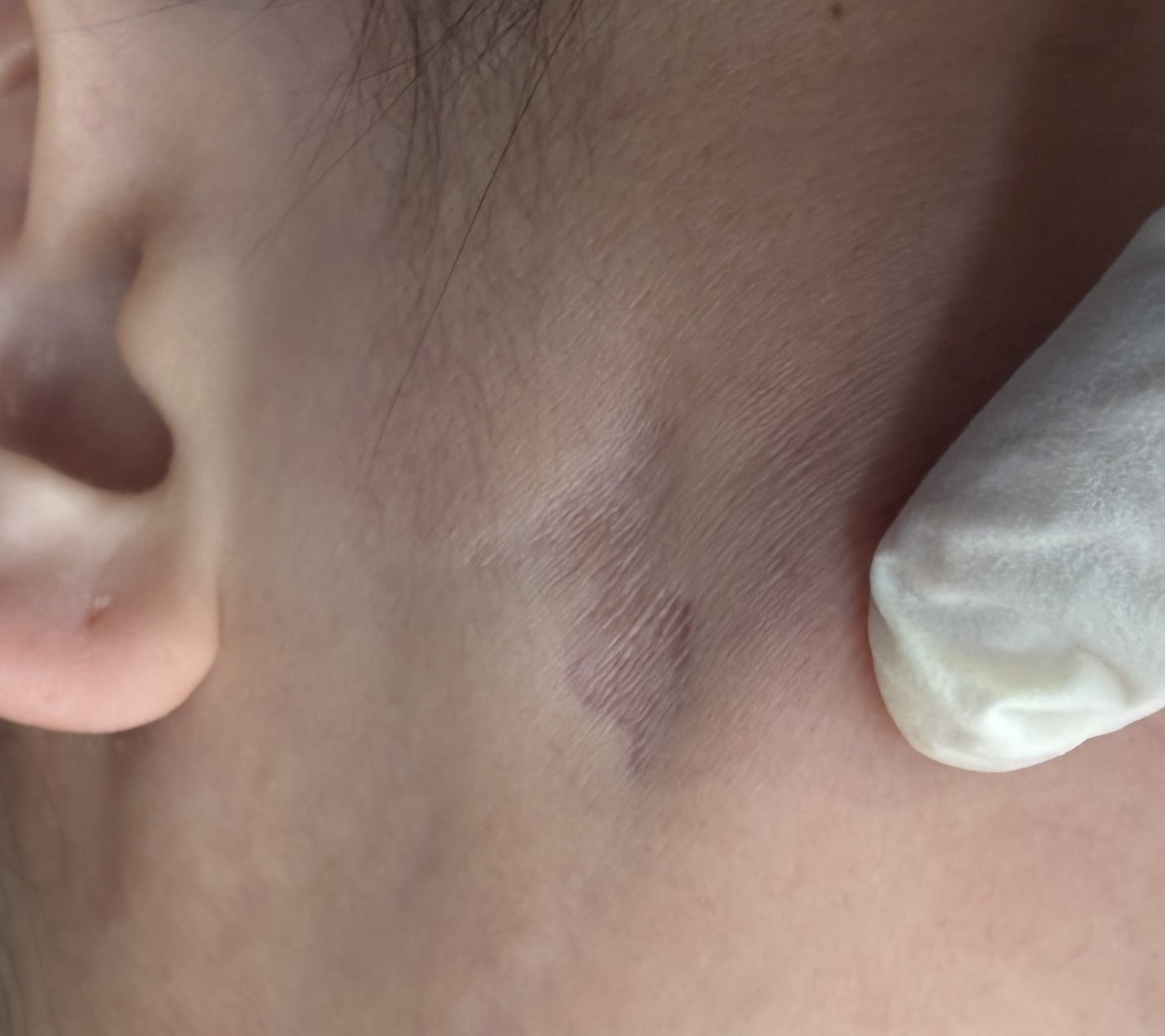 Real case: the pre-auricular cheek, documented at the first visit and not yet treated at this point, showing a darker depressed area with thinned skin and visible underlying vessels (image de-identified, shared with patient consent).