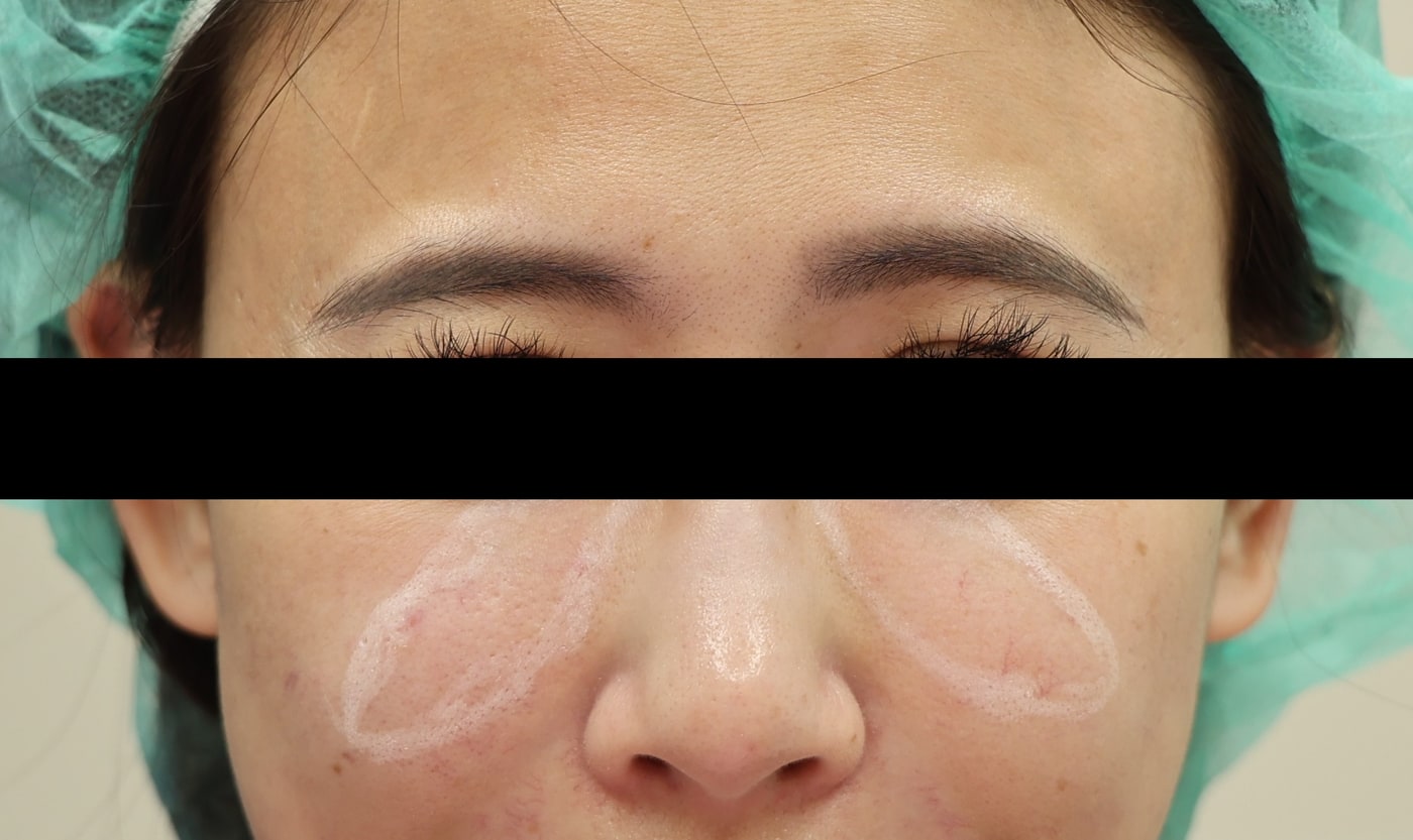 Real case: marking of the treatment area over both tear troughs and mid-cheeks before the first session (image de-identified, shared with patient consent).