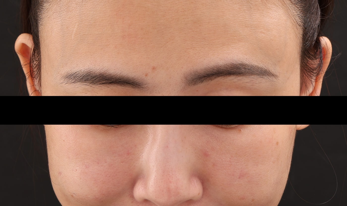 Real case: frontal view three weeks after those two areas were addressed; the temple and lateral cheek lumps are still untouched at this point and were treated later the same day (image de-identified, shared with patient consent).