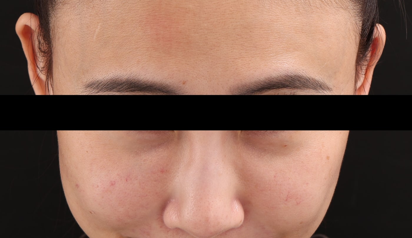 Real case: frontal view before the first session, with both tear troughs and mid-cheeks untreated (image de-identified, shared with patient consent).