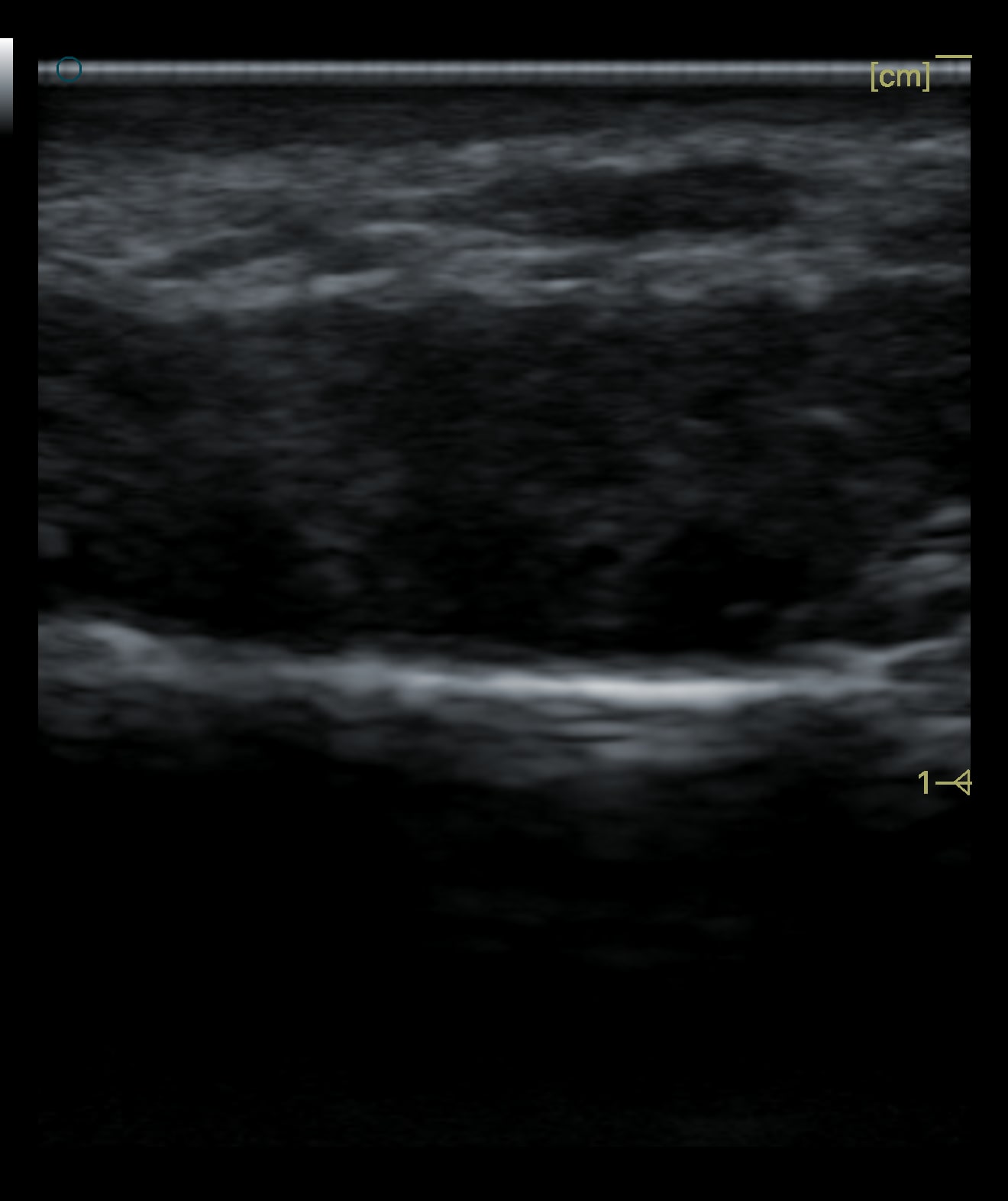 Real case: high-frequency ultrasound of the deep cheek showing a broad hypoechoic area where the material has become confluent (image de-identified, shared with patient consent).