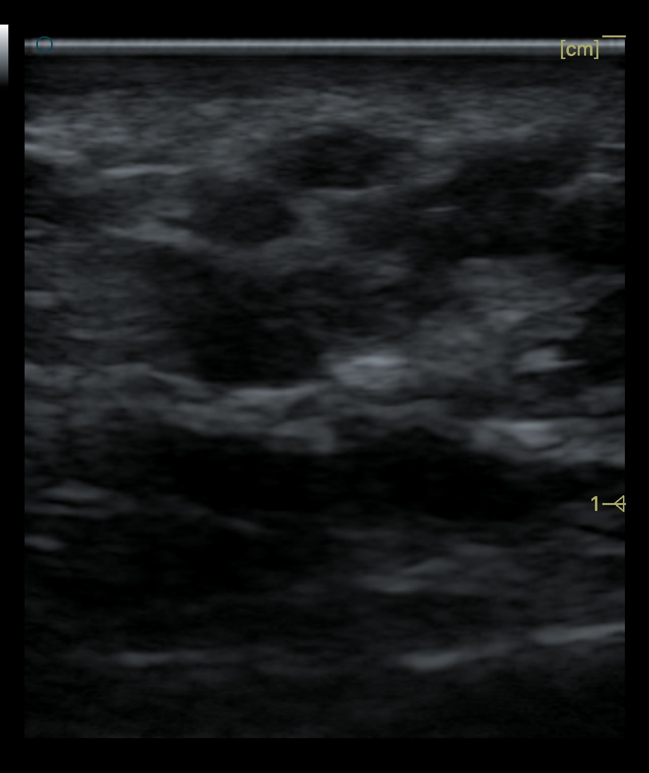 Real case: high-frequency ultrasound of another deep cheek site in the same patient, where the material is distributed as scattered particles rather than a single mass (image de-identified, shared with patient consent).