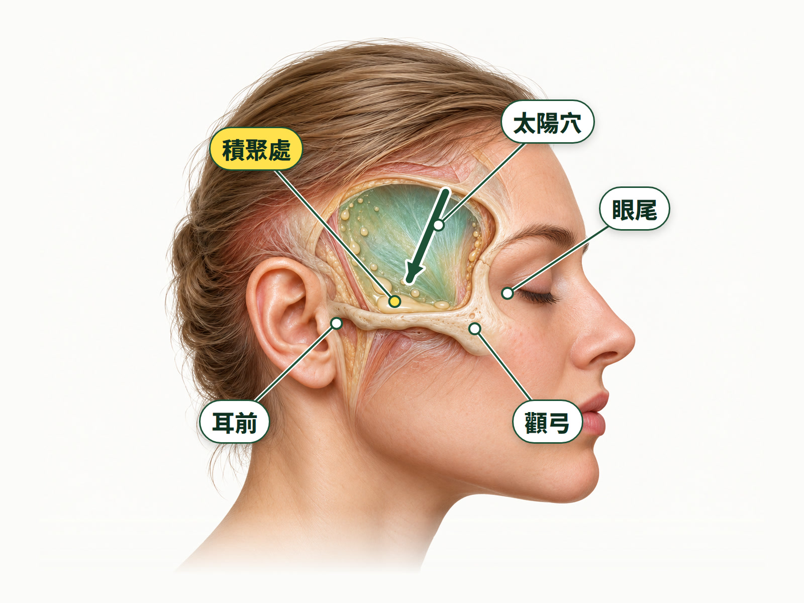 示意圖:太陽穴像一個碗,碗底在顴弓上方、眼尾外側到耳前,填充物會往碗底集中。