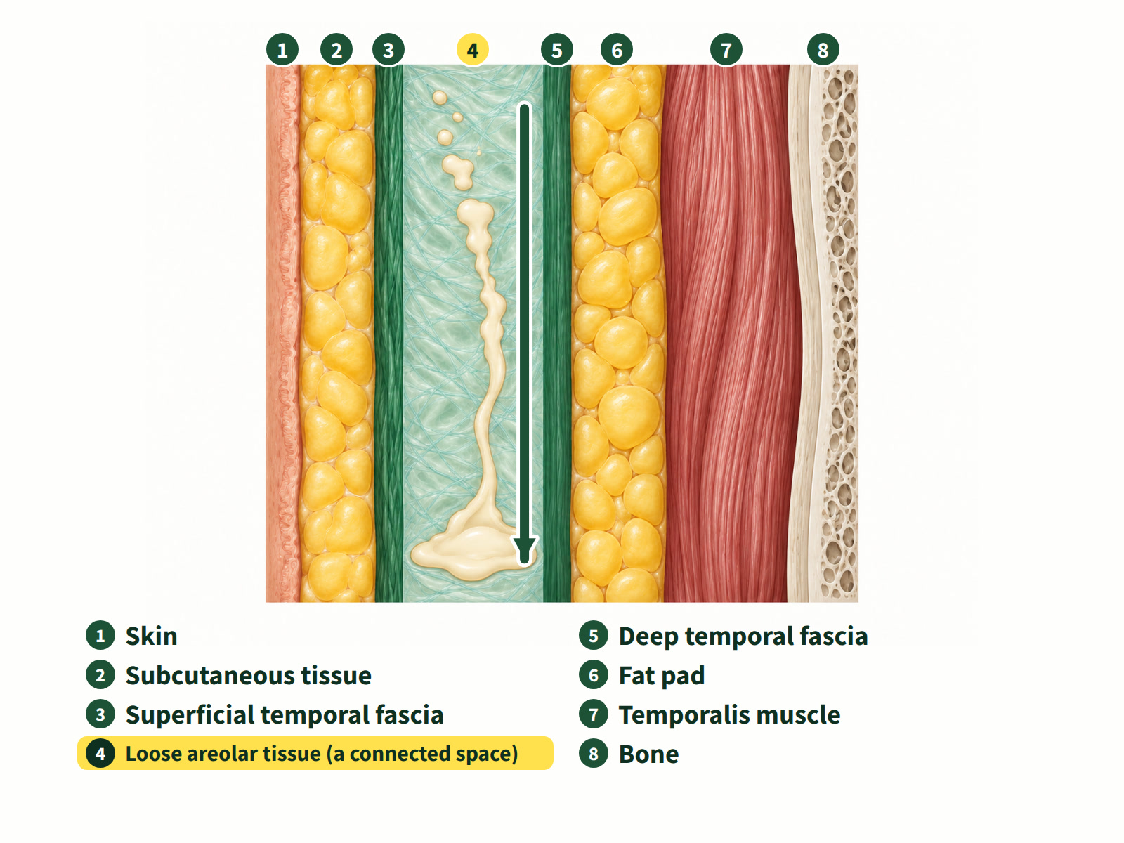 Illustration: cross-section of the temple layers. The loose tissue between the superficial and deep temporal fascia is one connected space, and filler can slide down within it.