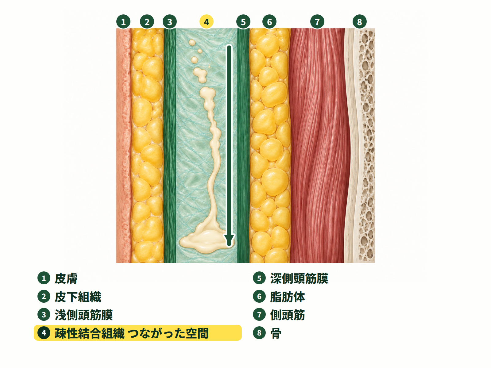 イラスト:こめかみの断面図。浅側頭筋膜と深側頭筋膜の間の疎性結合組織はつながった一つの空間で、フィラーはその中を下へ滑っていきます。
