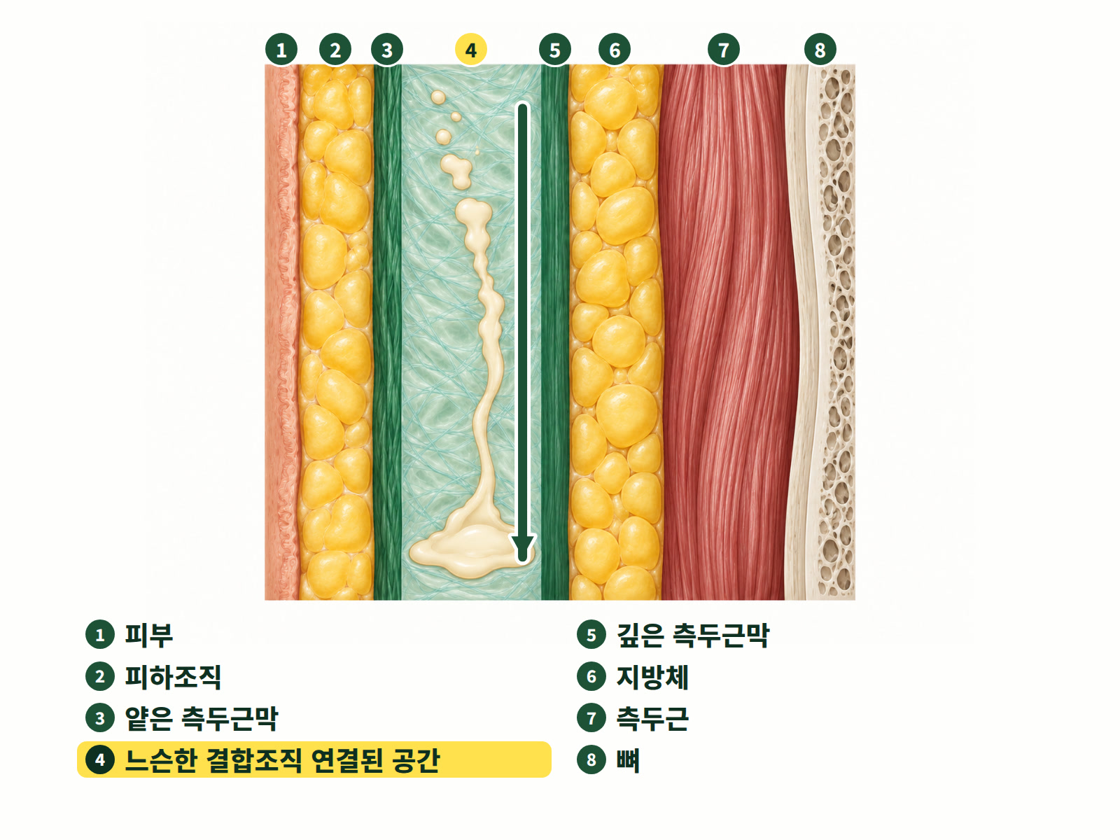그림: 관자놀이의 단면. 얕은 측두근막과 깊은 측두근막 사이의 느슨한 결합조직은 하나로 연결된 공간이며, 필러는 그 안에서 아래로 미끄러질 수 있습니다.