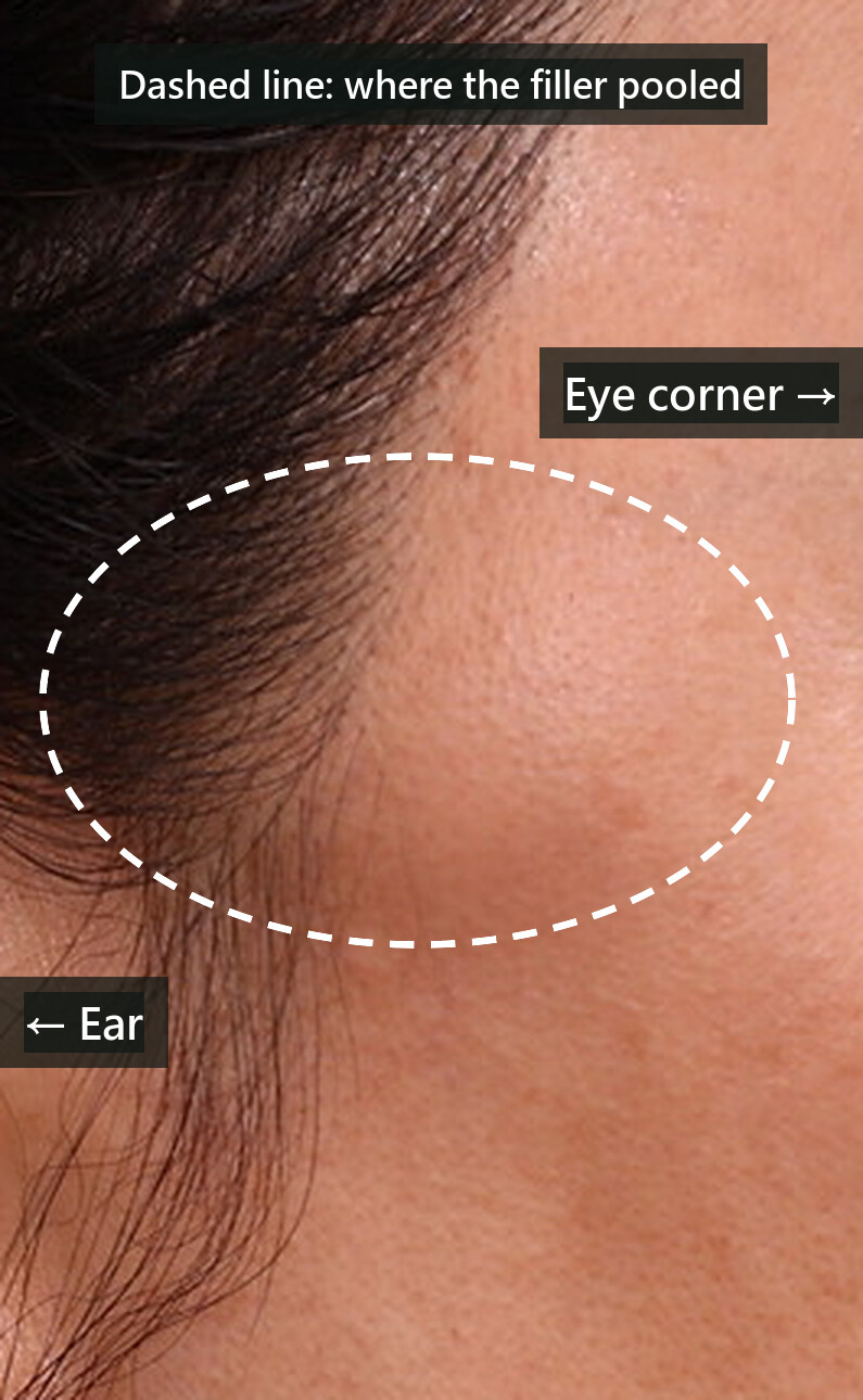 Real case: permanent filler injected into the temple ten years ago (remembered by the patient as liquid silicone; the removed material looked more like Amazingel), now bulging above the zygomatic arch and outside the eye corner (dashed line added for reference; photo de-identified and shared with the patient's consent).