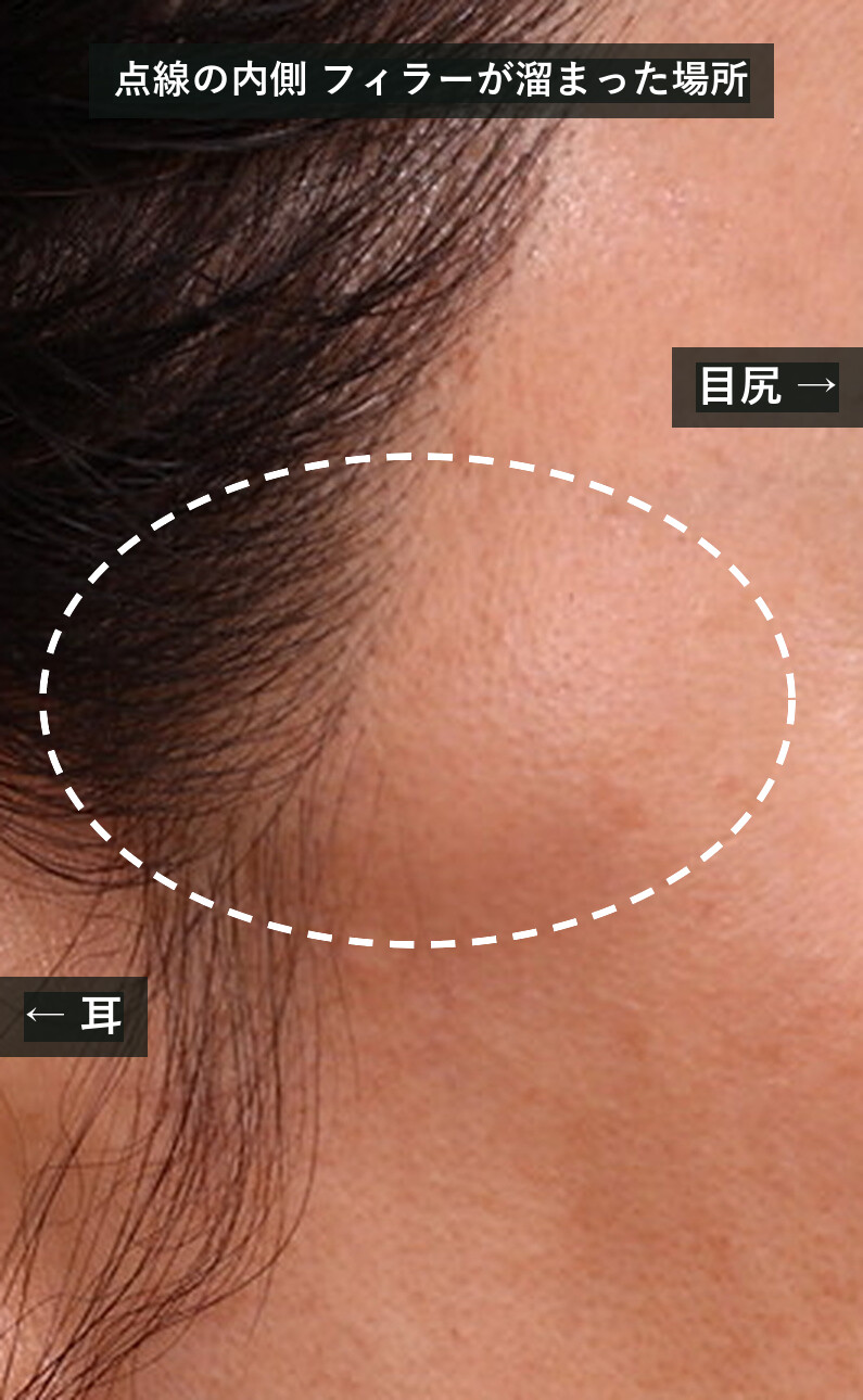 実際の症例:10年前にこめかみへ注入した永久フィラー(ご本人は液体シリコンと記憶、摘出物は奥美定に近い)が、頬骨弓の上、目尻の外側に膨らんでいます(点線は説明用の書き込み。写真は個人が特定できないよう加工し、患者さんの同意を得て掲載しています)。